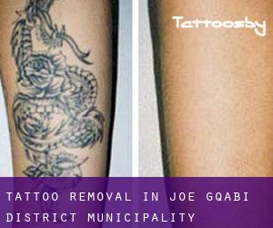 Tattoo Removal in Joe Gqabi District Municipality