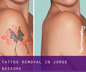 Tattoo Removal in Jorge Basadre