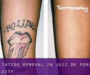 Tattoo Removal in Juiz de Fora (City)