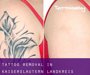 Tattoo Removal in Kaiserslautern Landkreis