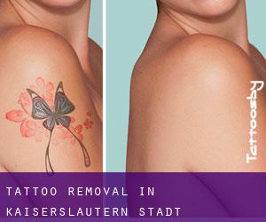 Tattoo Removal in Kaiserslautern Stadt