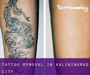 Tattoo Removal in Kaliningrad (City)