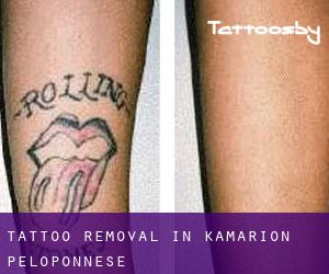 Tattoo Removal in Kamárion (Peloponnese)