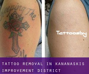 Tattoo Removal in Kananaskis Improvement District