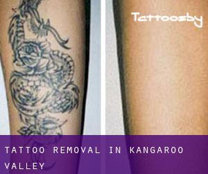 Tattoo Removal in Kangaroo Valley