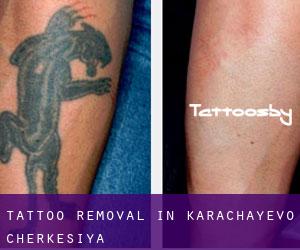 Tattoo Removal in Karachayevo-Cherkesiya