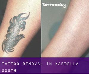 Tattoo Removal in Kardella South