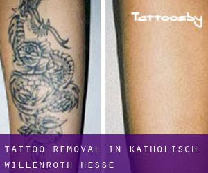Tattoo Removal in Katholisch-Willenroth (Hesse)