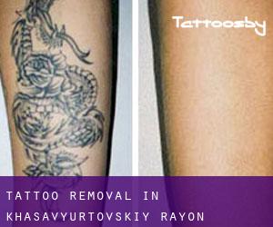 Tattoo Removal in Khasavyurtovskiy Rayon