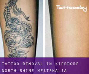 Tattoo Removal in Kierdorf (North Rhine-Westphalia)