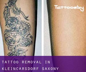 Tattoo Removal in Kleincarsdorf (Saxony)