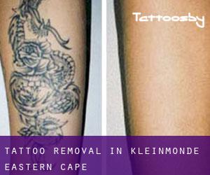 Tattoo Removal in Kleinmonde (Eastern Cape)