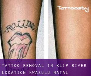 Tattoo Removal in Klip River Location (KwaZulu-Natal)