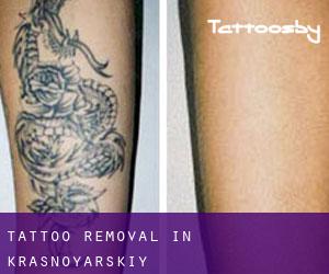 Tattoo Removal in Krasnoyarskiy