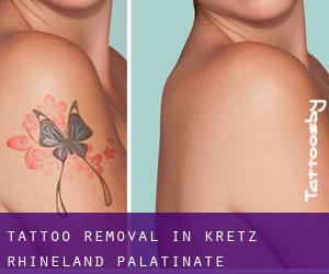 Tattoo Removal in Kretz (Rhineland-Palatinate)