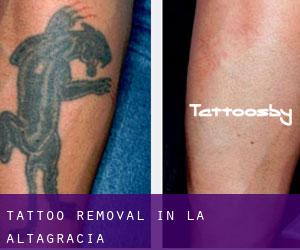 Tattoo Removal in La Altagracia