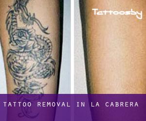 Tattoo Removal in La Cabrera