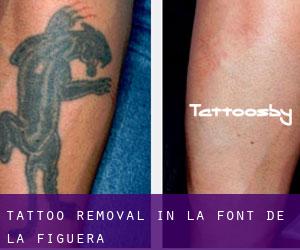 Tattoo Removal in La Font de la Figuera