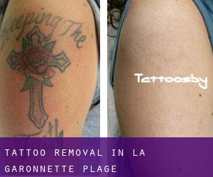 Tattoo Removal in La Garonnette-Plage