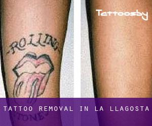 Tattoo Removal in La Llagosta