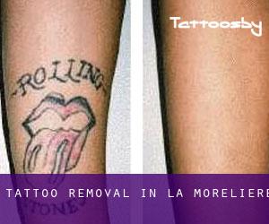Tattoo Removal in La Morelière