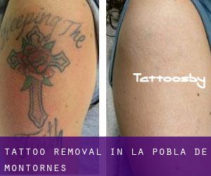 Tattoo Removal in la Pobla de Montornès