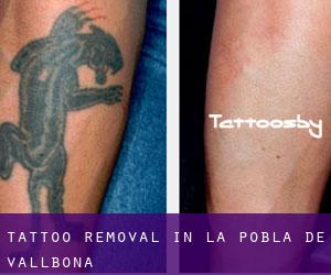 Tattoo Removal in La Pobla de Vallbona