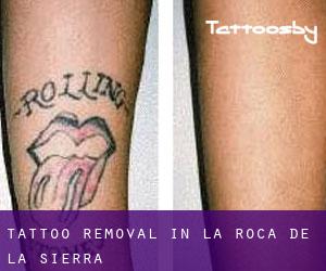 Tattoo Removal in La Roca de la Sierra