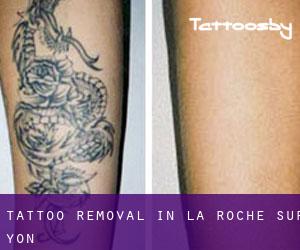 Tattoo Removal in La Roche-sur-Yon