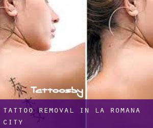 Tattoo Removal in La Romana (City)