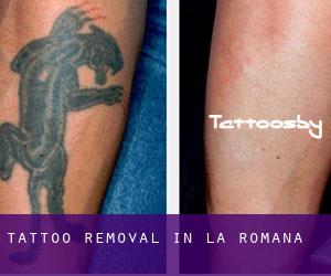 Tattoo Removal in La Romana