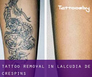 Tattoo Removal in L'Alcúdia de Crespìns