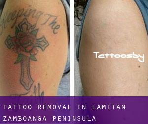 Tattoo Removal in Lamitan (Zamboanga Peninsula)
