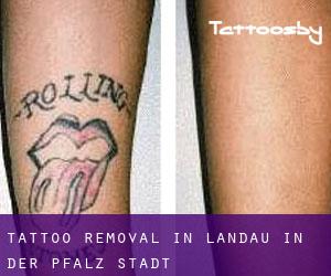 Tattoo Removal in Landau in der Pfalz Stadt