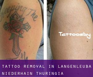 Tattoo Removal in Langenleuba-Niederhain (Thuringia)