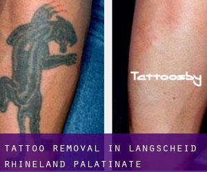 Tattoo Removal in Langscheid (Rhineland-Palatinate)