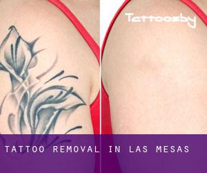 Tattoo Removal in Las Mesas