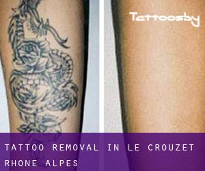 Tattoo Removal in Le Crouzet (Rhône-Alpes)