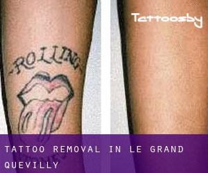 Tattoo Removal in Le Grand-Quevilly
