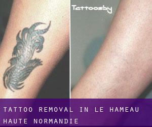Tattoo Removal in Le Hameau (Haute-Normandie)