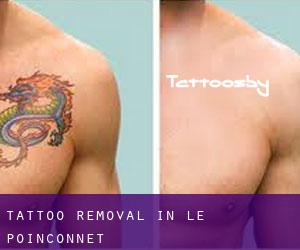 Tattoo Removal in Le Poinçonnet
