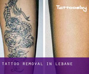Tattoo Removal in Lebane