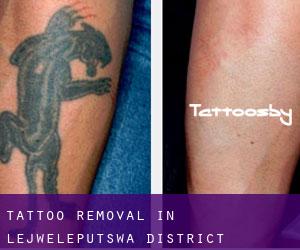 Tattoo Removal in Lejweleputswa District Municipality