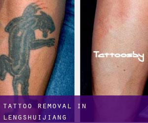 Tattoo Removal in Lengshuijiang