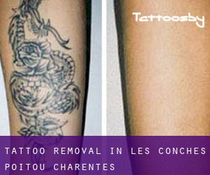 Tattoo Removal in Les Conches (Poitou-Charentes)