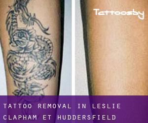Tattoo Removal in Leslie-Clapham-et-Huddersfield