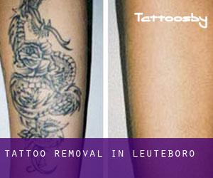 Tattoo Removal in Leuteboro