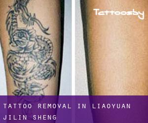 Tattoo Removal in Liaoyuan (Jilin Sheng)