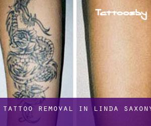 Tattoo Removal in Linda (Saxony)