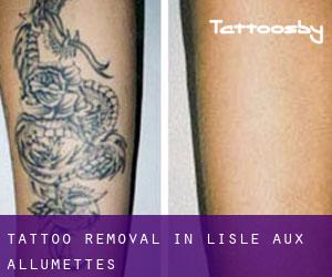 Tattoo Removal in L'Isle-aux-Allumettes